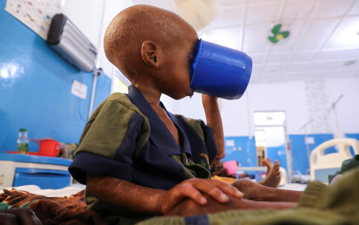 UNICEF warns surge in child malnutrition as aid to Somalia shrinks